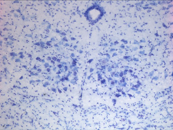 Amyotrophic lateral sclerosis