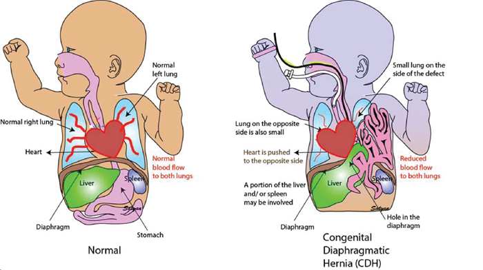 Diagram comparing the organs of a normal infant to one with Congenital Diaphragmatic Hernia