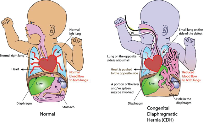 Congenital Diaphragmatic Hernia Cdh Research Duke Department Of