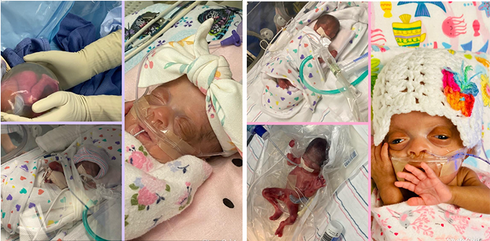Six photos of newborn twins in intensive care